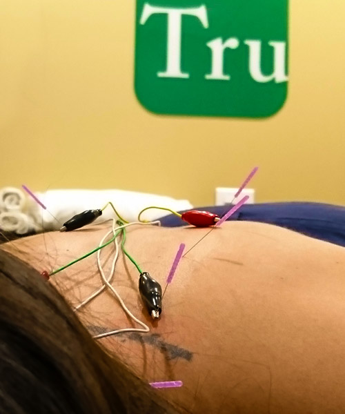 Electro-acupuncture treatment at TruChange Naturopathic in Cambridge